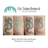 City Tattoo Removal image 3